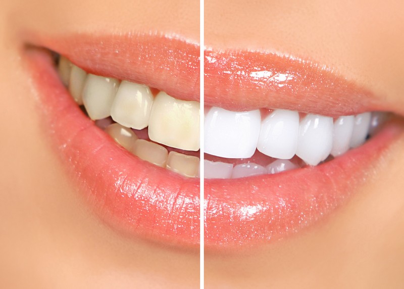Teeth Whitening  Dayton, TX 